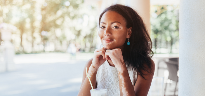 Woman with vitiligo